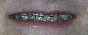 child smiling wearing metal braces